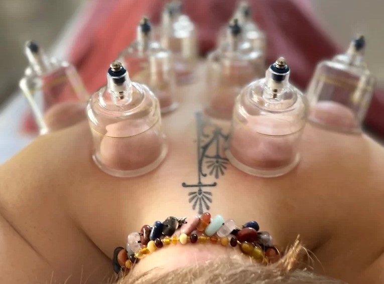 cupping