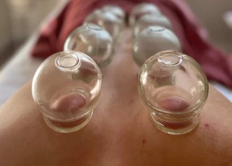 cupping
